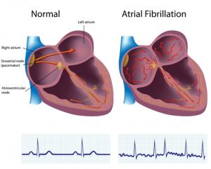 Life insurance with AFib